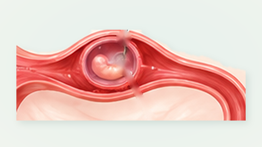 Close-up medical illustration of a tubal ectopic pregnancy within the fallopian tube, no labels
