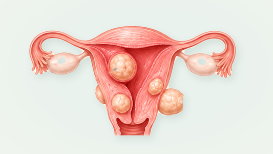 Medical illustration of uterine fibroids located within and around the muscular wall, no labels