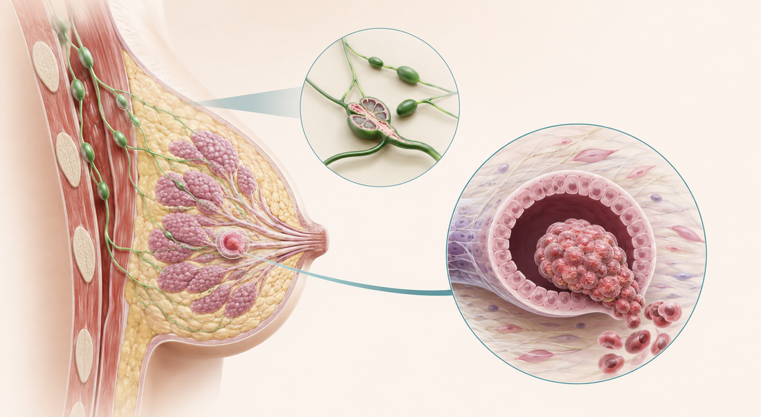 Anatomical breast illustration showing abnormal cell growth and lymphatic spread