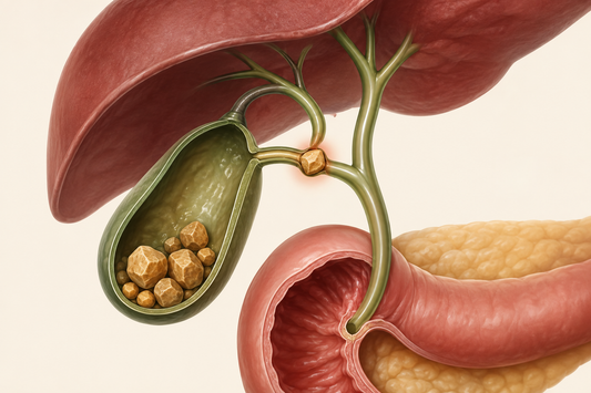 Anatomical illustration of gallstones within the gallbladder and a stone obstructing the biliary tract